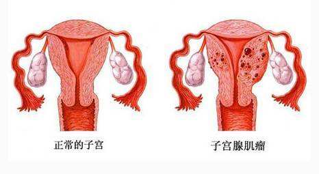 子宮肌瘤是如何導(dǎo)(dǎo)致流產(chǎn)(chǎn)和不孕的