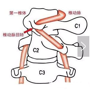 偏頭痛該怎么辦？
