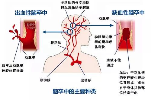 世界卒中日 | 識別卒中早一秒，挽救大腦恢復(fù)好