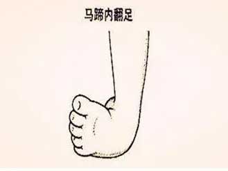 一旦發(fā)(fā)現(xiàn)(xiàn)孩子“腳彎彎”? 需要您 “足”夠重視