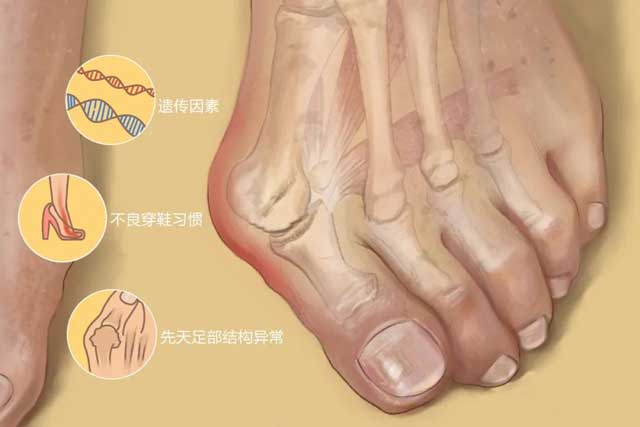 常穿高跟鞋、尖頭鞋女性謹(jǐn)防拇外翻的發(fā)(fā)生！
