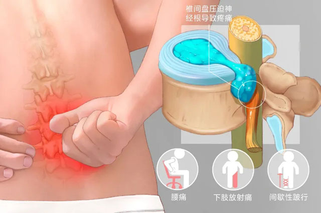 腰痛、下肢放射痛謹(jǐn)(jǐn)防腰間盤突出，早查早治是關(guān)(guān)鍵！