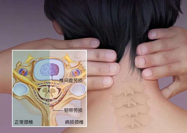 頸椎病誤區(qū)(qū)多，如何避“坑”少走彎路？