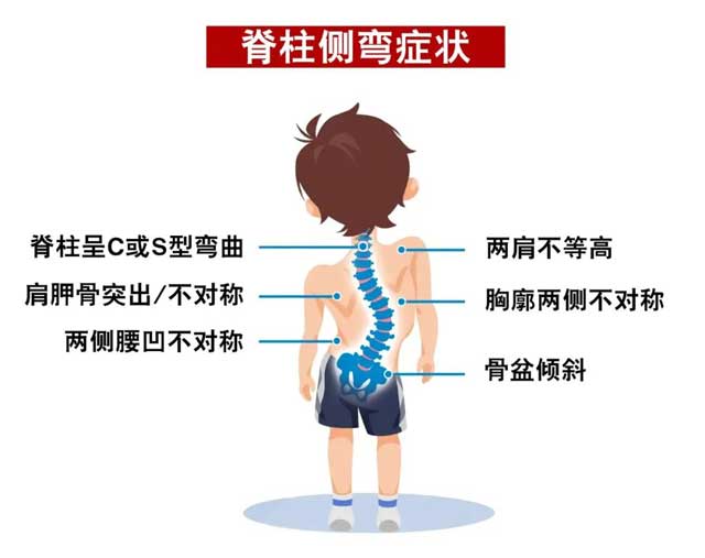 5.21脊柱健康日，家長(zhǎng)要嚴(yán)防孩子脊柱側(cè)(cè)彎的發(fā)(fā)生！