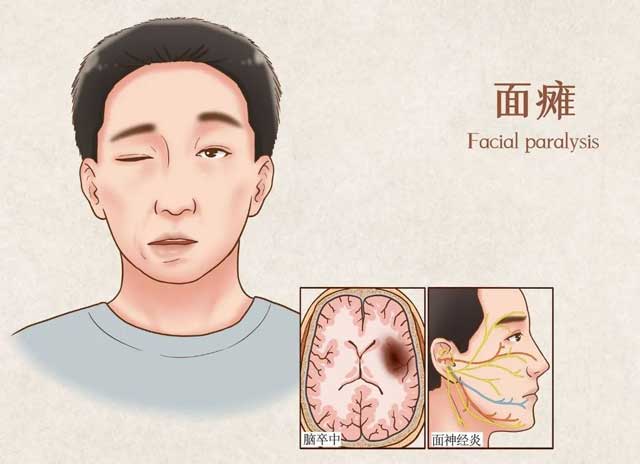 面癱的常見(jiàn)原因知多少？神經(jīng)(jīng)修復(fù)(fù)事半功倍